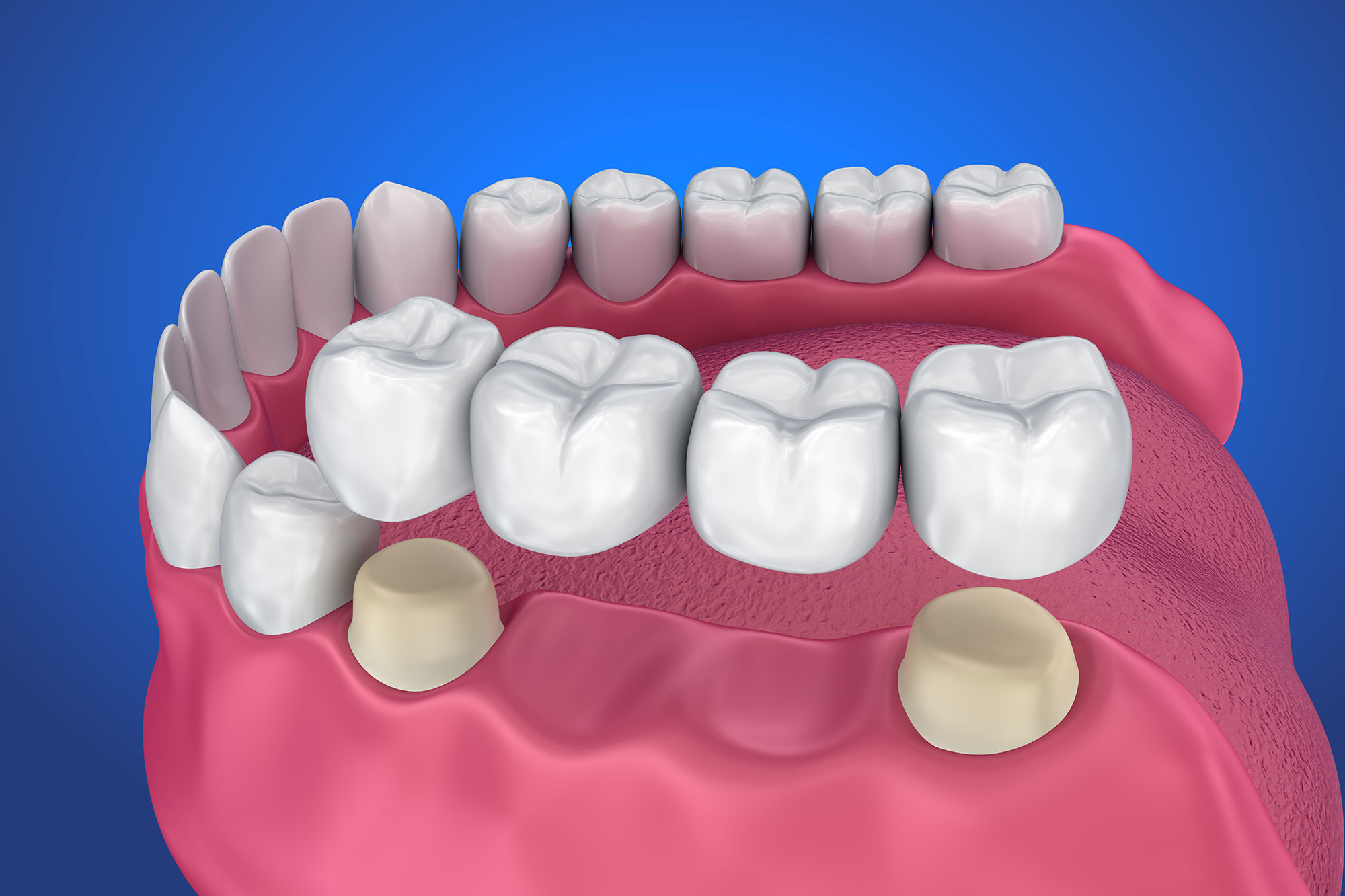 Full Mouth Reconstruction Steps