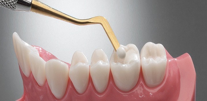 Inlays, Onlays, and Fillings: Know the Difference