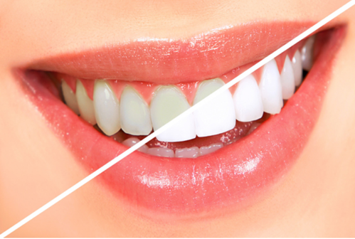 Teeth Whitening Services At Parkway Dental