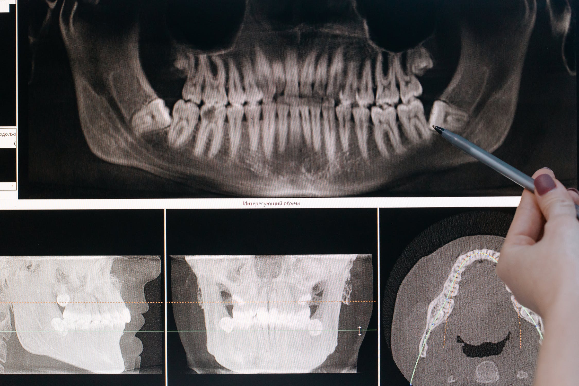 Treatments for tooth decay in Hamden, CT