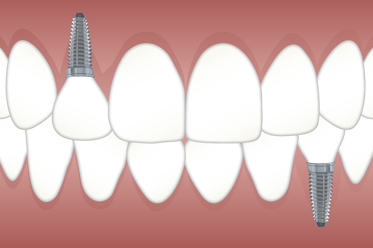 Why Dental Implants may be the future of your Smile in Hamden